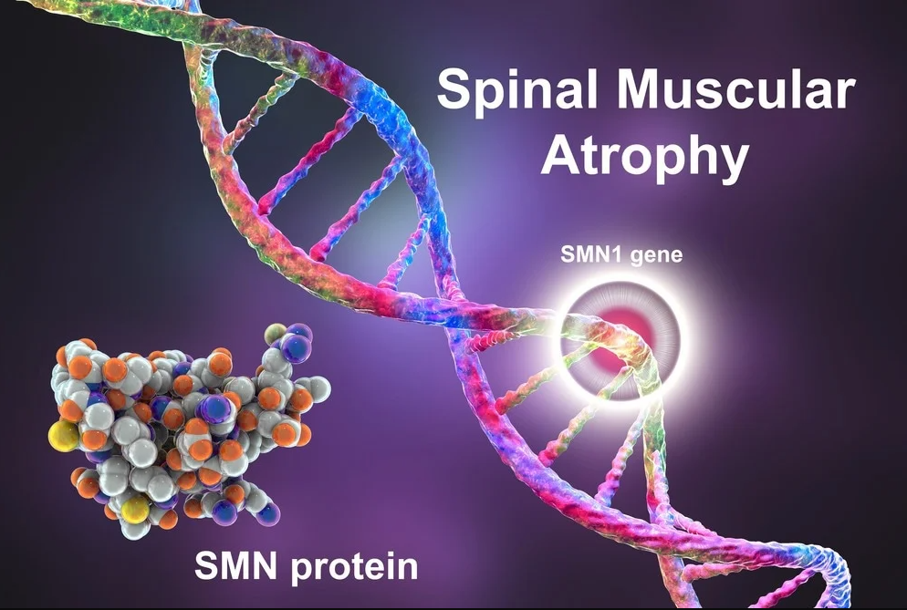 Spinal Muscular Atrophy: A Comprehensive Guide